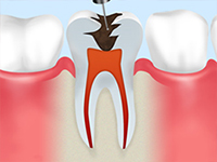 STEP1 歯の神経・血管の除去