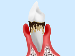 年齢を重ねるごとにリスクが高まる歯周病
